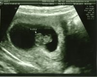 baby scan 8 wks - 2.jpg