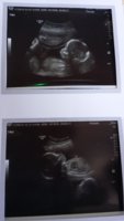20 week scanb.jpg