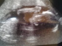 Boo Boo scan 23 weeks.4th November 2011 1.jpg