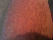 rash%20thigh.jpg