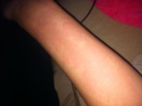 Rash v1.JPG