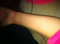 Rash v2.JPG